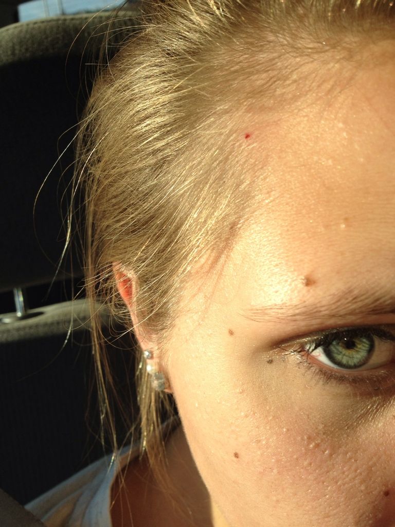Urgent Is That Tiny Black Dot On Your Scalp Dangerous - tphn4by