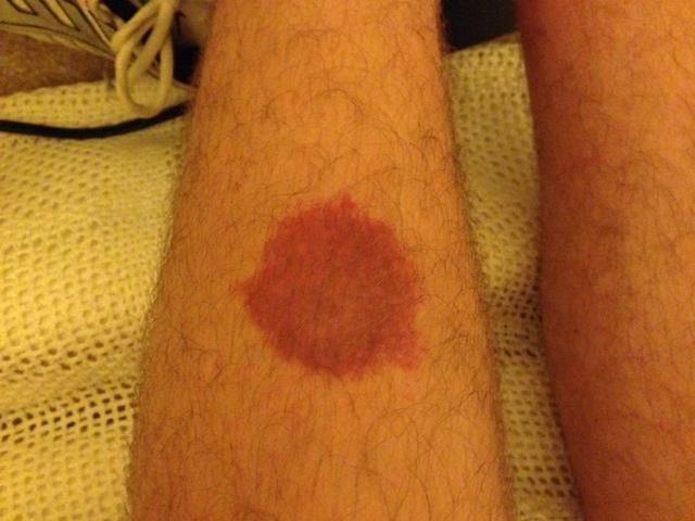 Help Have A Weird Circular Red Rash On Leg Skin Problems