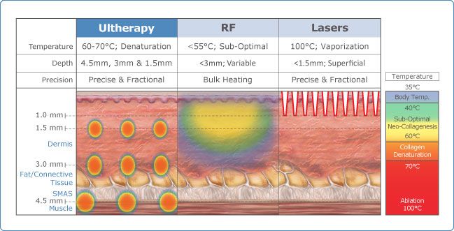 photo ultherapy-overview_zps29e85423.jpg
